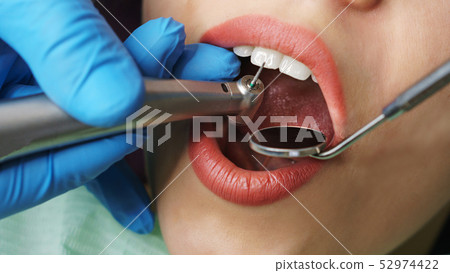 Dentist treats girl's teeth. Dentist treats girl's teeth. 52974422