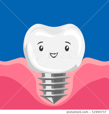 Illustration of smiling tooth implant. 52994737