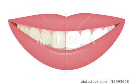 Teeth Whitening Before and After. Vector Illustartion 52995698