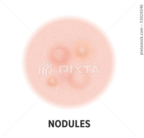 Nodules skin acne type vector icon. Skin disease 53029346
