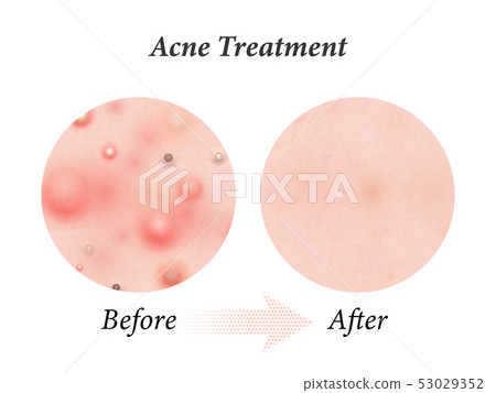 Skin acne treatment before and after. Vector skin 53029352