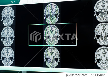 MRI indicated Dementia MRI indicated Dementia 53145884