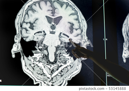 MRI indicated Dementia MRI indicated Dementia 53145888
