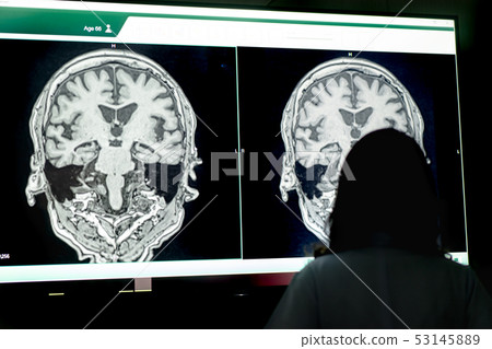 MRI indicated Dementia MRI indicated Dementia 53145889