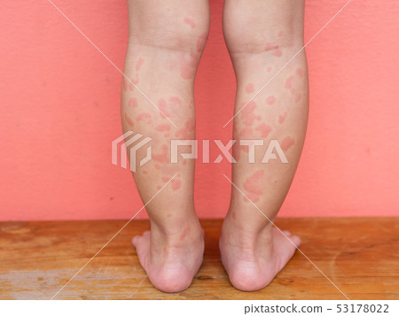 Child with symptoms of itchy urticaria at legs. Child with symptoms of itchy urticaria at legs. 53178022
