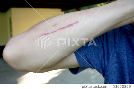 Men have wounds on the skin around the arms Men have wounds on the skin around the arms 53630899