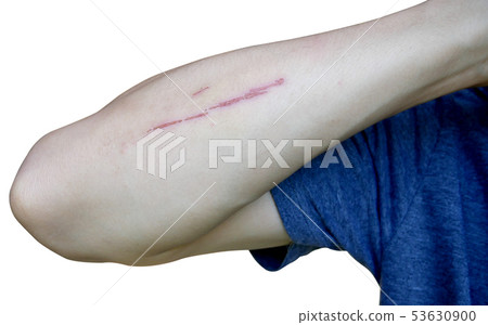 Men have wounds on the skin around the arms on a Men have wounds on the skin around the arms on a 53630900