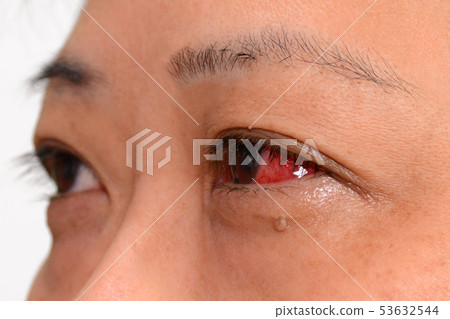 Person Parts Eye Subconjunctival bleeding 3 53632544