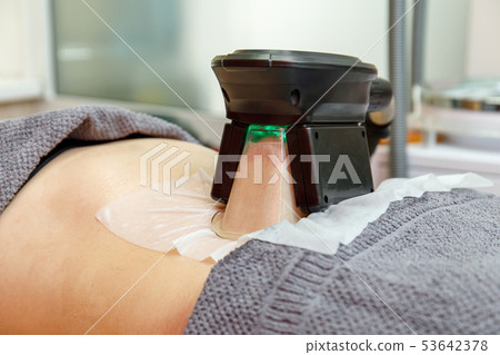 Cryolipolysis freeze fat procedure 53642378