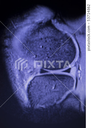 MRI knee meniscus tear scan MRI knee meniscus tear scan 53714862
