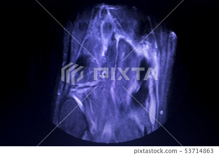 MRI knee meniscus tear scan MRI knee meniscus tear scan 53714863