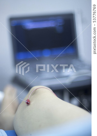 EPI dry needling ultrasound scan 53776769