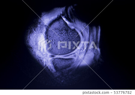 MRI knee meniscus tear scan MRI knee meniscus tear scan 53776782