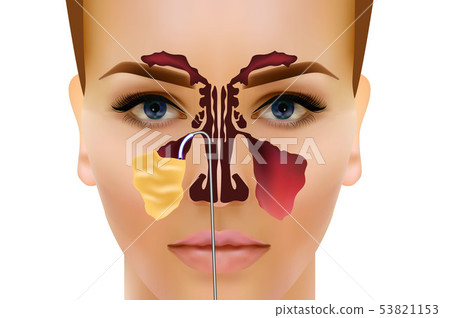 Sinusitis. Healthy and inflammation nasal sinus vector illustration Sinusitis. Healthy and inflammation nasal sinus vector illustration 53821153