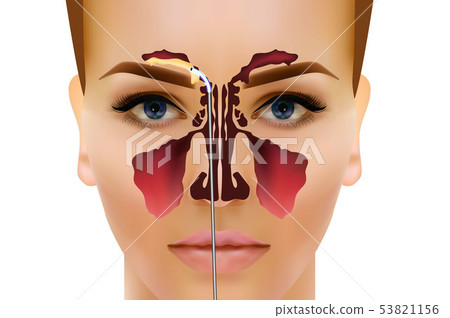 Sinusitis. Healthy and inflammation nasal sinus vector illustration Sinusitis. Healthy and inflammation nasal sinus vector illustration 53821156