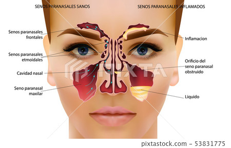 Sinusitis. Healthy and inflammation nasal sinus vector illustration Sinusitis. Healthy and inflammation nasal sinus vector illustration 53831775