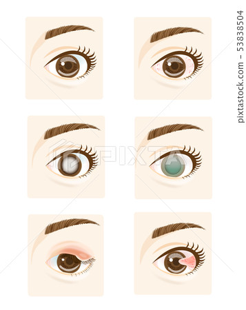 Eye disease 53838504