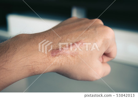 Scar on human skin keloid on hand. 53842013