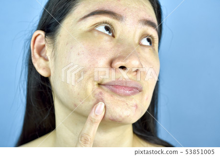 Asian woman finger point at whitehead acne. 53851005