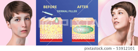Cosmetic filler or dermal fillers 53912101