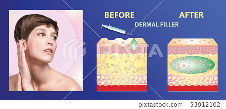 Cosmetic filler or dermal fillers 53912102