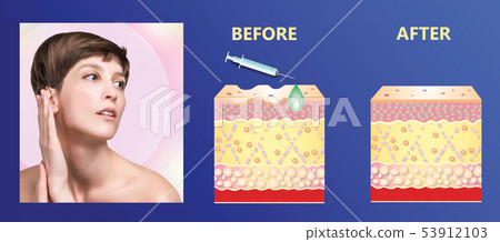Cosmetic filler or dermal fillers 53912103