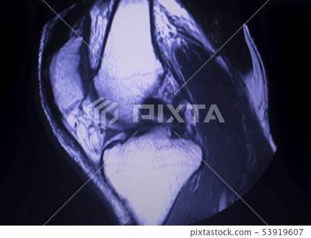 MRI knee meniscus tear scan MRI knee meniscus tear scan 53919607