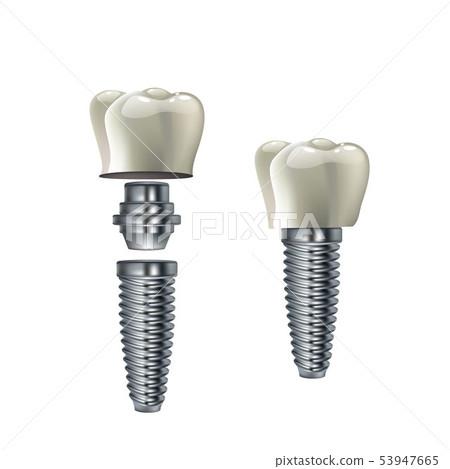 Dental implant vector illustration - humant teeth medical infographic poster 53947665