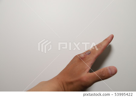 Viral wart treatment 53995422