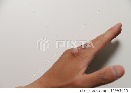 Viral wart treatment Viral wart treatment 53995423