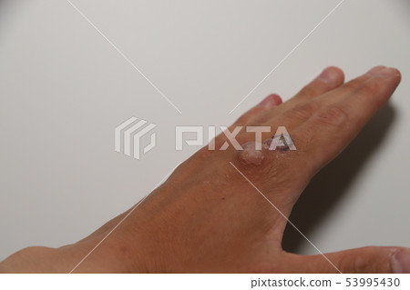 Viral wart treatment 53995430