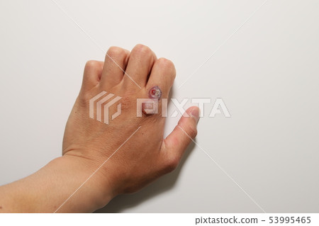 Viral wart treatment 53995465