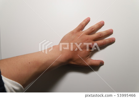 Viral wart treatment 53995466