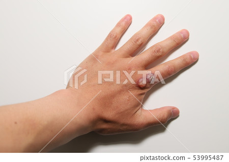 Viral wart treatment Viral wart treatment 53995487