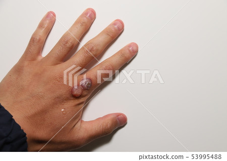 Viral wart treatment Viral wart treatment 53995488