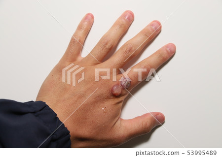 Viral wart treatment Viral wart treatment 53995489