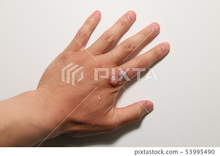 Viral wart treatment Viral wart treatment 53995490