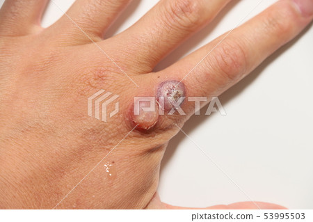 病毒疣治療 53995503