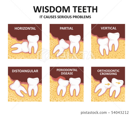 Wisdom tooth. Possible problems because of the third molar Wisdom tooth. Possible problems because of the third molar 54043212