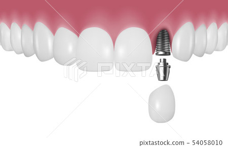 Vector 3d Realistic Render Human Teeth with Implant Closeup Isolated on White Background. Dentistry 54058010