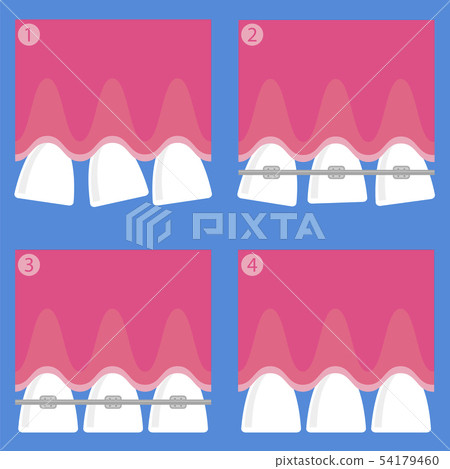 Braces Teeth. Dental Care Background. Orthodontic Treatment. Cartoon Opening Mouth. 54179460