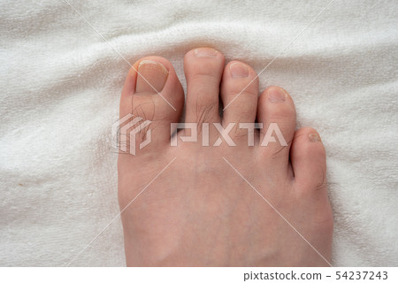 Men's toe hair removal before image Men's toe hair removal before image 54237243