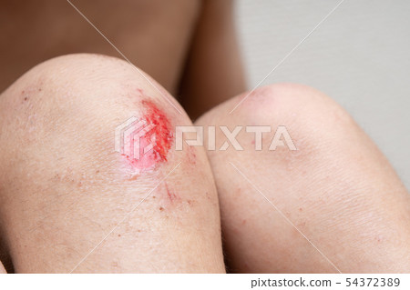 Knee injury of a child 54372389