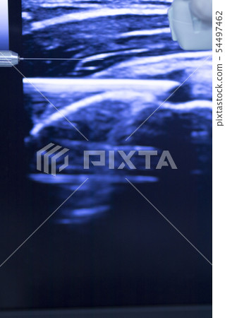 EPI dry needling ultrasound scan EPI dry needling ultrasound scan 54497462