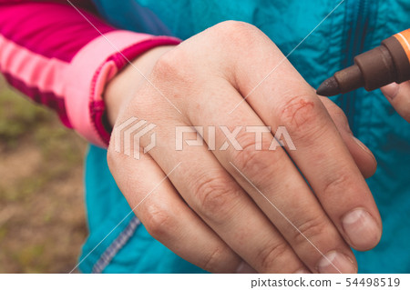 Injured hand with open cut, iodine-treated. Injured hand with open cut, iodine-treated. 54498519