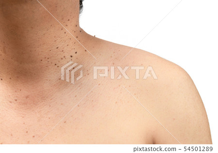 Closed up the skin tags or Seborrheic Keratosis on Closed up the skin tags or Seborrheic Keratosis on 54501289
