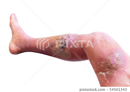 Erysipelas bacterial infection Under the skin leg 54501343