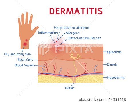 Dermatitis graphic diagram or scheme flat style Dermatitis graphic diagram or scheme flat style 54531318