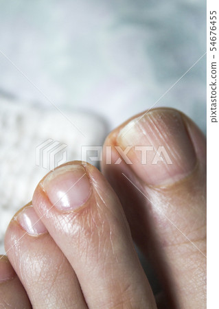 Toenail with fungus 54676455