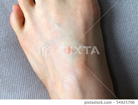 Dermatitis Skin trouble Rough skin Eczema Insect bites Case 5 Dermatitis Skin trouble Rough skin Eczema Insect bites Case 5 54925706